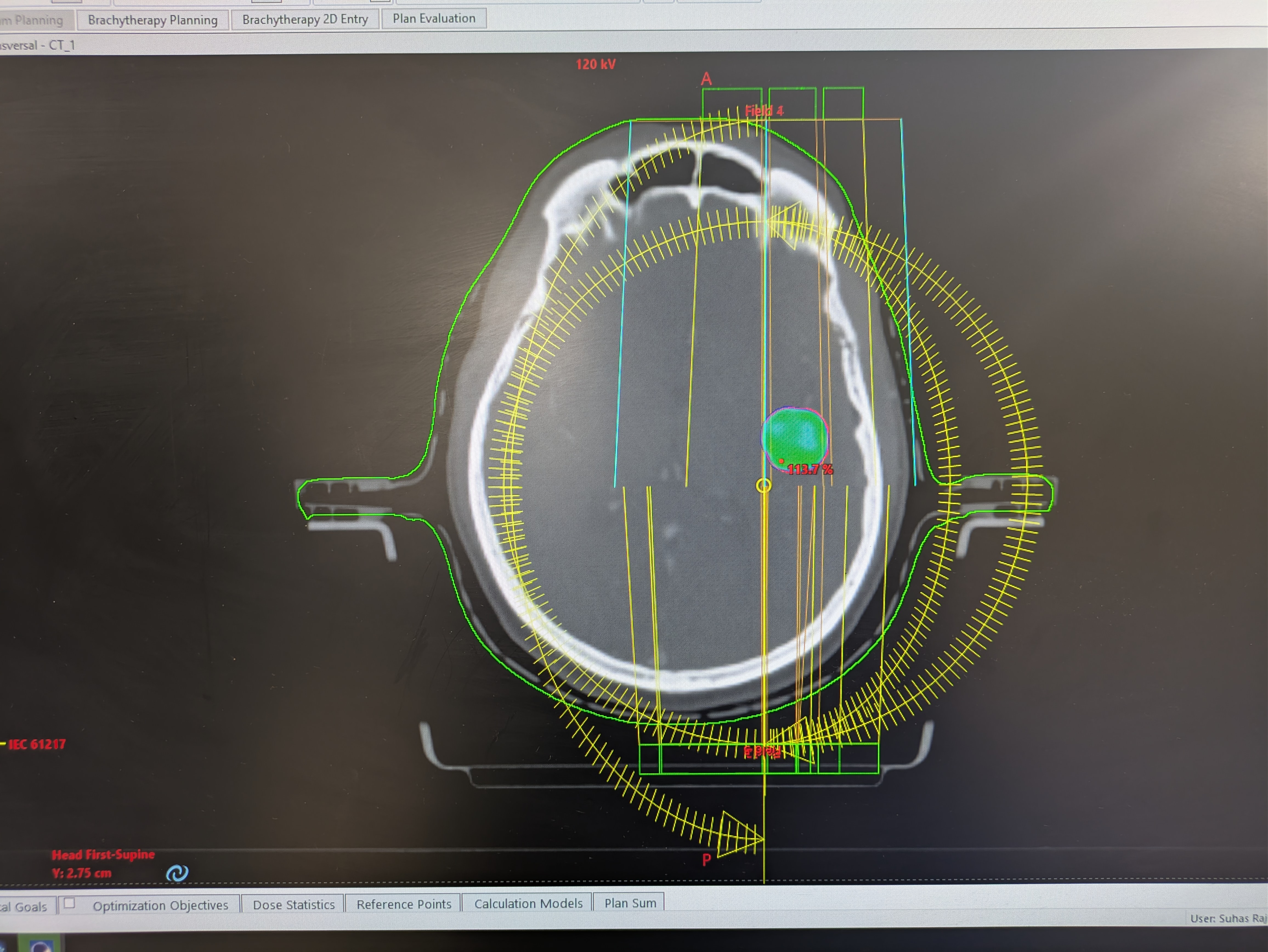Halcyon Radiation Therapy System